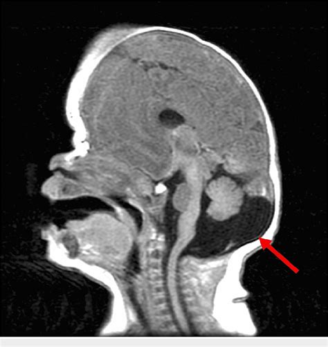 Mega Cisterna Magna: Understanding an Enlarged Cisterna Magna  .